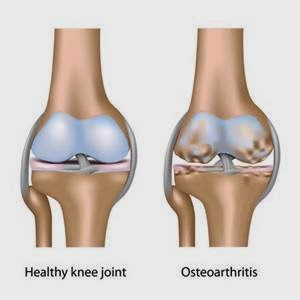 Acupuncture Cure Knee Joint Pain